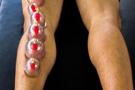 Cupping therapy